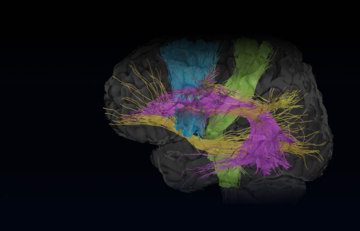 mri scanner, cognitie, onderzoek, connectiviteit, hersentraining, Cognitieve training, Cognitivefx, hersentraining, training reactievermogen, reactievermogen, aandacht, geheugen, fMRI, functionele MRI, geert-jan Rutten, paul depauw, Hazem al-khawaja, Vera Heyms, fysiotherapie, neurochirurgie, hersentumor, ETZ, Elisabeth-TweeSteden ziekenhuis, ziekenhuis, kliniek, revalidatiekliniek, revalidatiearts, hoofdpijn, overprikkeling, niet aangeboren hersenletsel, NAH, hersenschudding, klachten, duizelig, concentratie, nekpijn, prikkelgevoelig, gevoelig voor licht, gevoelig voor geluid, emoties, frustratie, beperkingen, beperkt, visuele training, neuromusculaire training, neurocracker, fitlights, fysieke training, sensomotorische training, blazepods