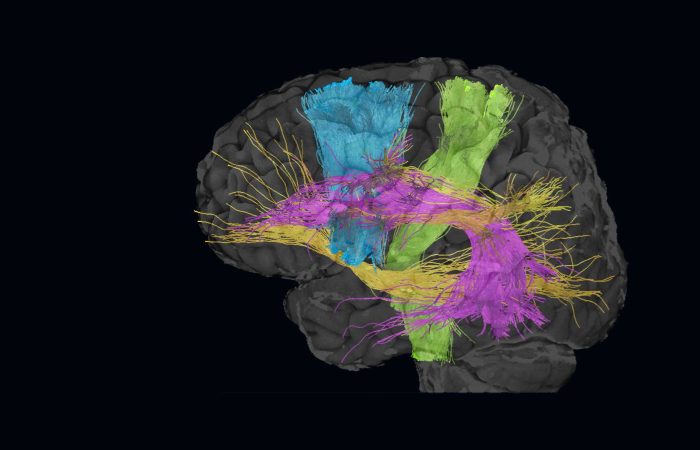 mri scanner, cognitie, onderzoek, connectiviteit, hersentraining, Cognitieve training, Cognitivefx, hersentraining, training reactievermogen, reactievermogen, aandacht, geheugen, fMRI, functionele MRI, geert-jan Rutten, paul depauw, Hazem al-khawaja, Vera Heyms, fysiotherapie, neurochirurgie, hersentumor, ETZ, Elisabeth-TweeSteden ziekenhuis, ziekenhuis, kliniek, revalidatiekliniek, revalidatiearts, hoofdpijn, overprikkeling, niet aangeboren hersenletsel, NAH, hersenschudding, klachten, duizelig, concentratie, nekpijn, prikkelgevoelig, gevoelig voor licht, gevoelig voor geluid, emoties, frustratie, beperkingen, beperkt, visuele training, neuromusculaire training, neurocracker, fitlights, fysieke training, sensomotorische training, blazepods